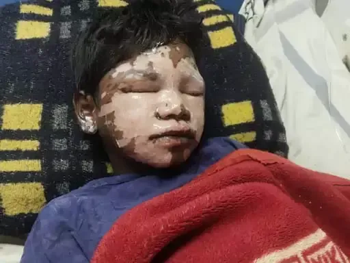 बकावंड: बालक छात्रावास में बड़ी लापरवाही, खौलते तेल से छात्र का चेहरा झुलसा